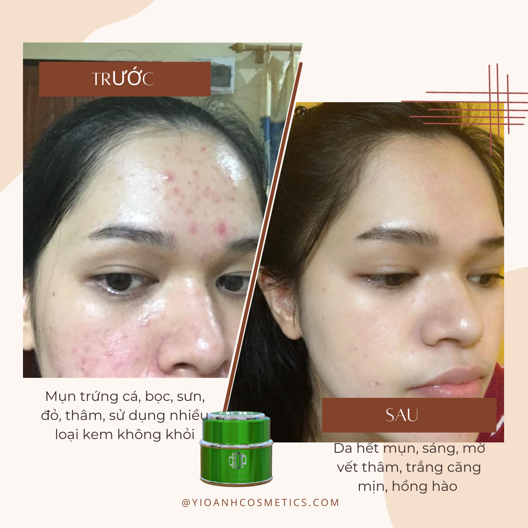 Kem Mụn - Thâm Mụn Acne Cream