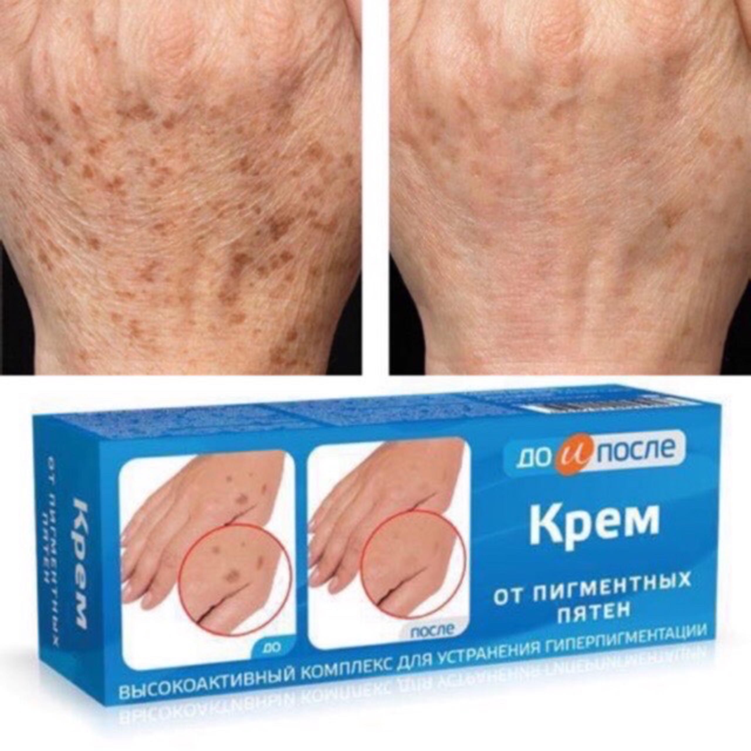[HCM]Kem bôi mờ đồi mồi Nga Kpem