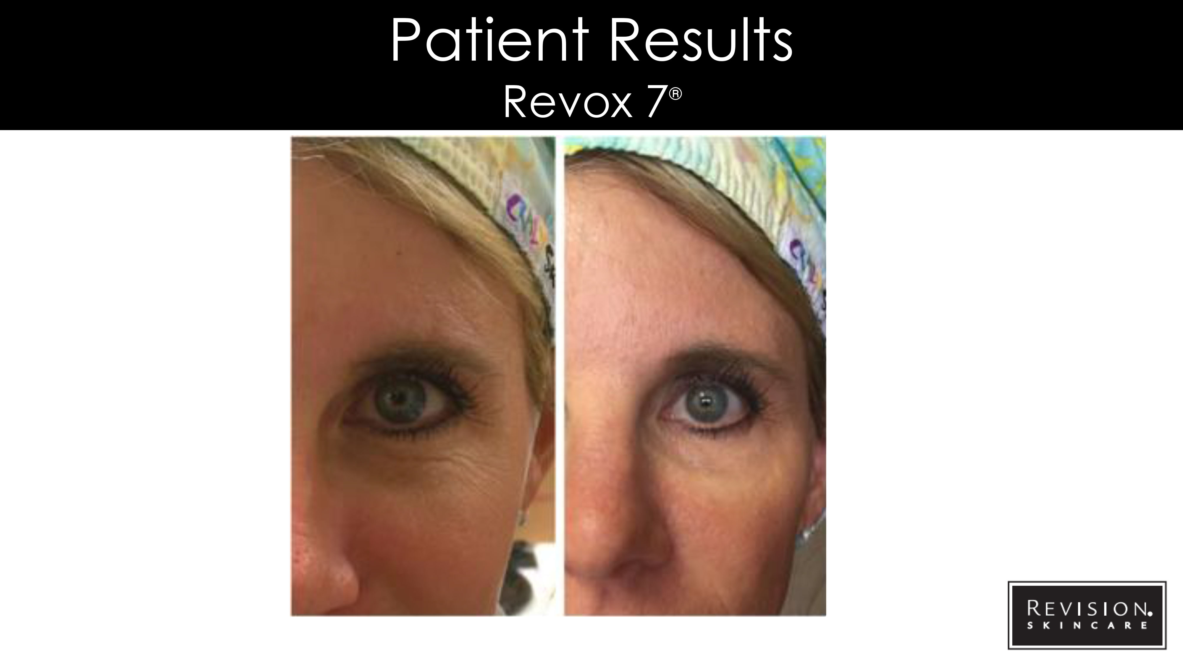 revision eye cream reviews