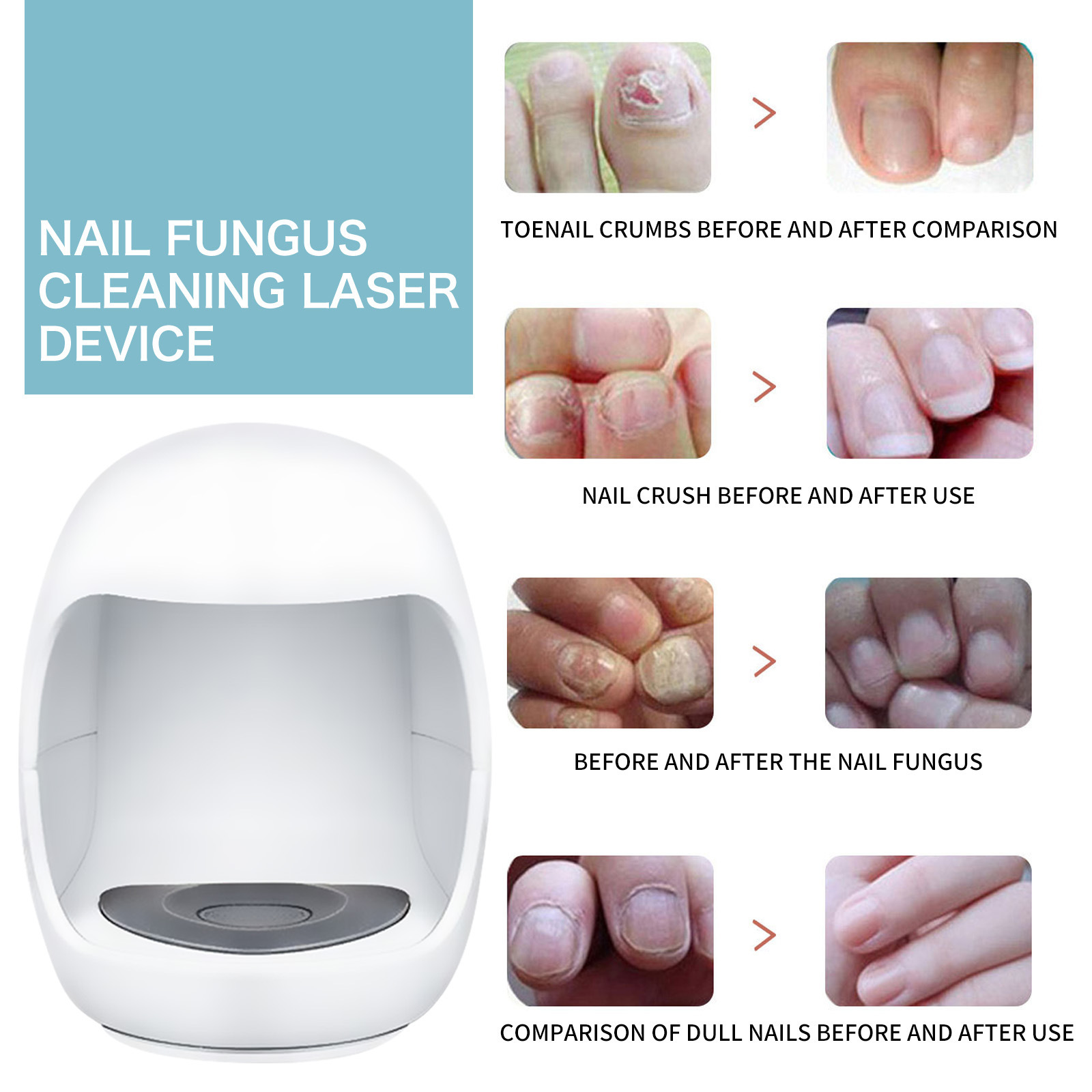 Toenail Machine Zhitian Luxury Nail Fungus Laser Treatment Device Repair Toenail ...
