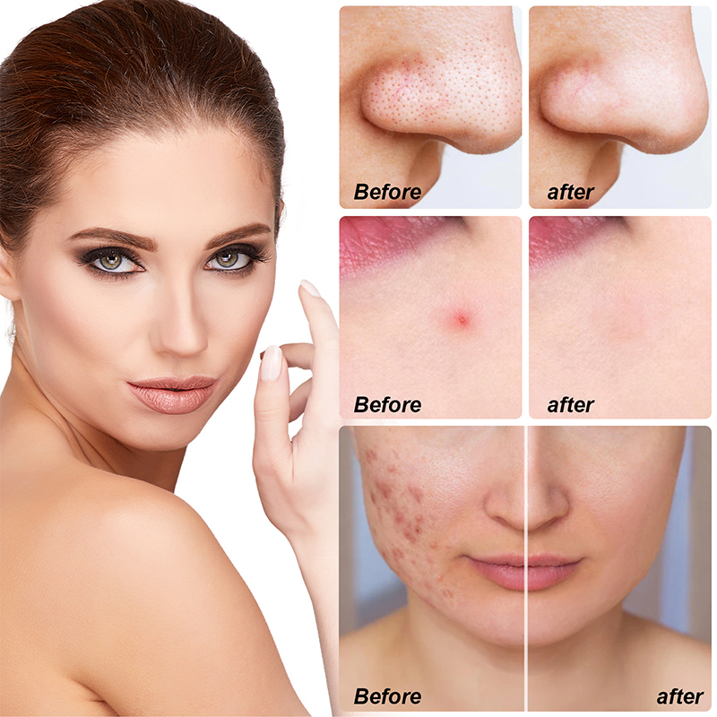 Pimple Protection Large Hydrocolloid Patch Acne Removal Full Face Pimple Patches Protect ...