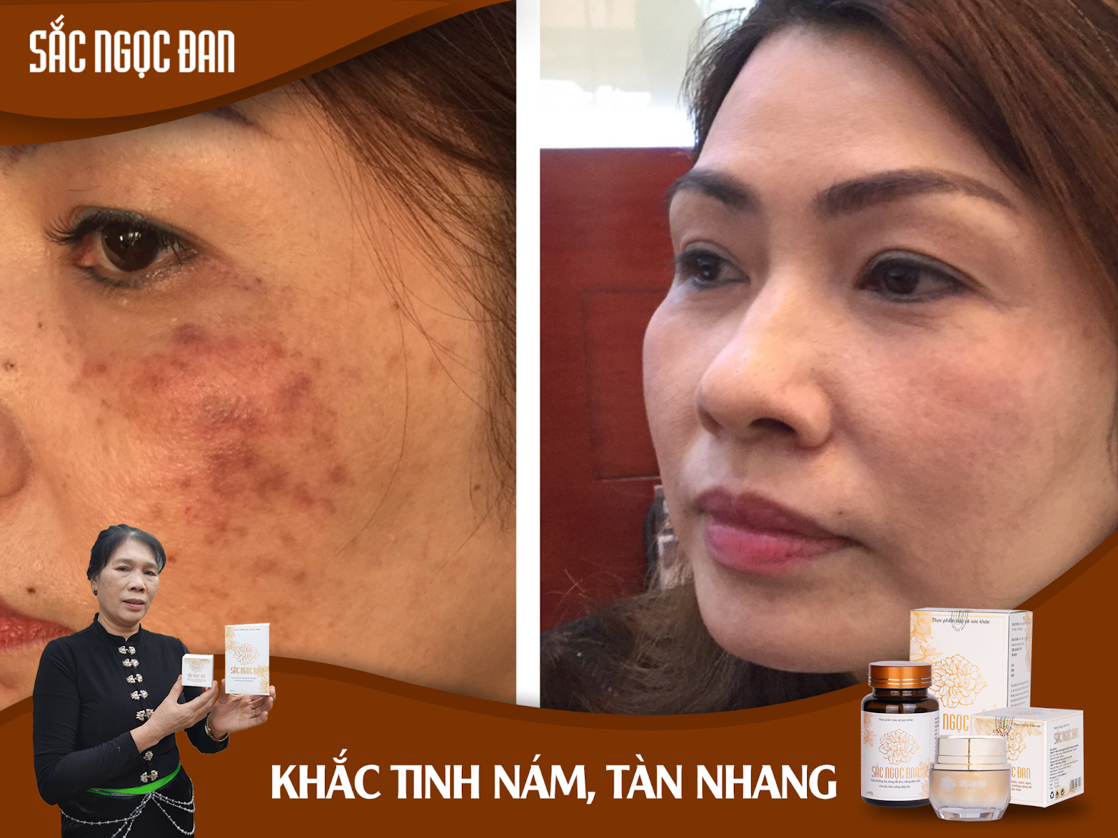 Sắc Ngọc Đan - Xóa mờ thâm nám, tàn nhang