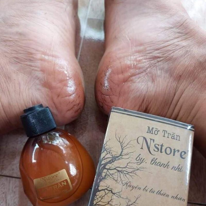 Triệt lông vĩnh viễn bằng mỡ trăn N’store