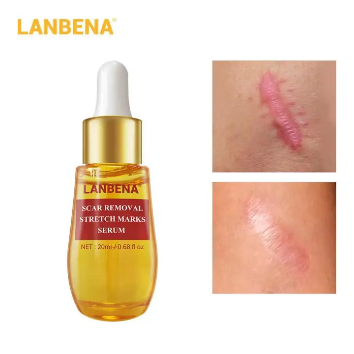 lanbena stretch mark removal