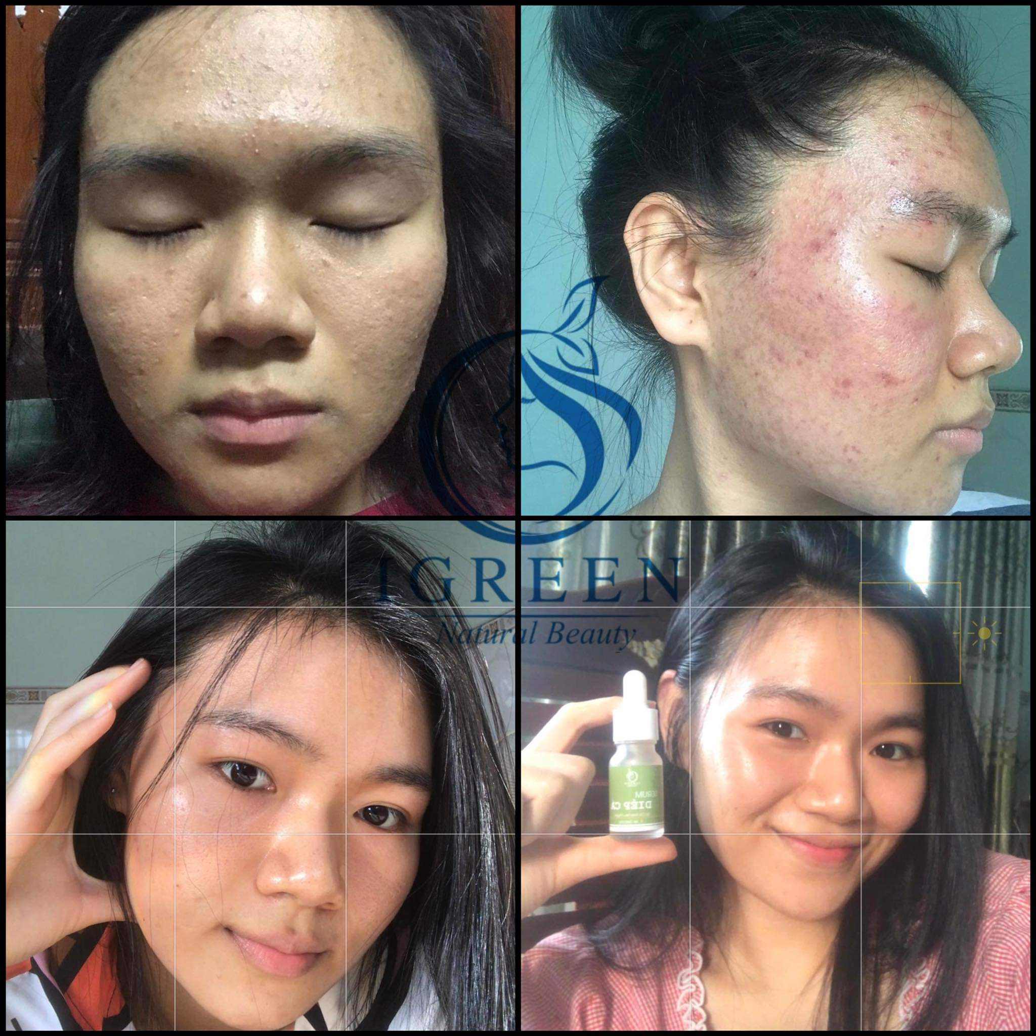 Serum diếp cá