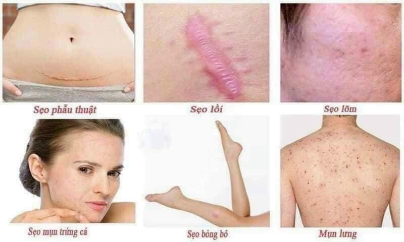 Kem Sẹo Noscarna Hàn Quốc ( Mẫu mới 2023 )