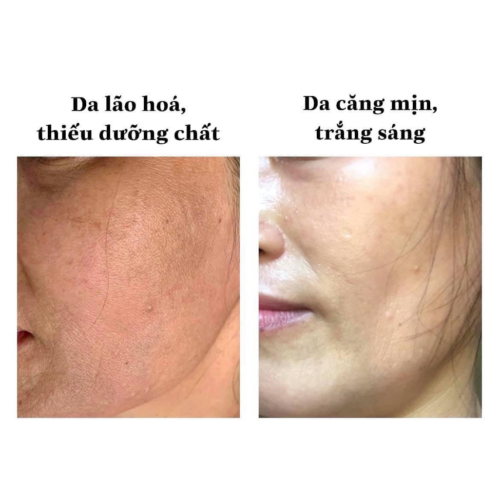 Kem đào thải nám Malasma K MIGA 30gr
