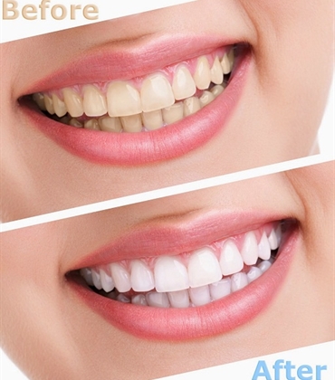 Kem đánh răng trắng răng Colgate Total Advanced Whitening Toothpaste 181g - USA (trắng răng- ngừa sâu răng - không ê buốt)