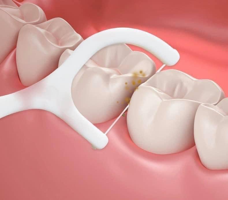 Bộ chỉ nha khoa chăm sóc răng miệng