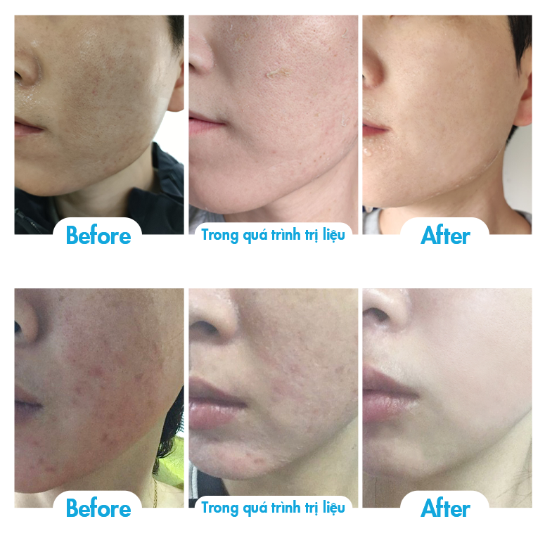 Siêu vi kim trẻ hoá da 10ml