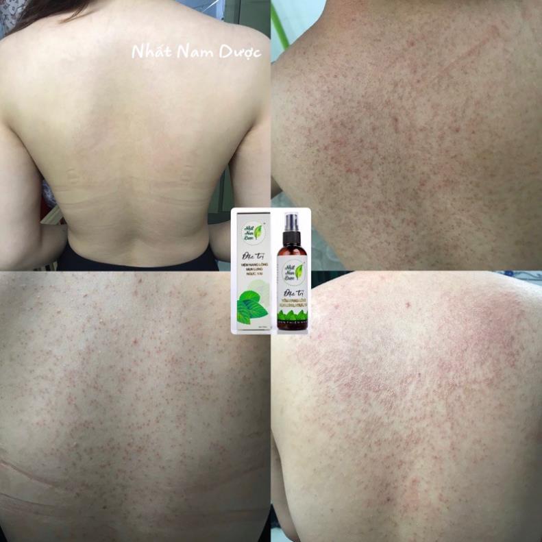 Xịt mụn lưng Hoàng Thiên Sâm 100ml