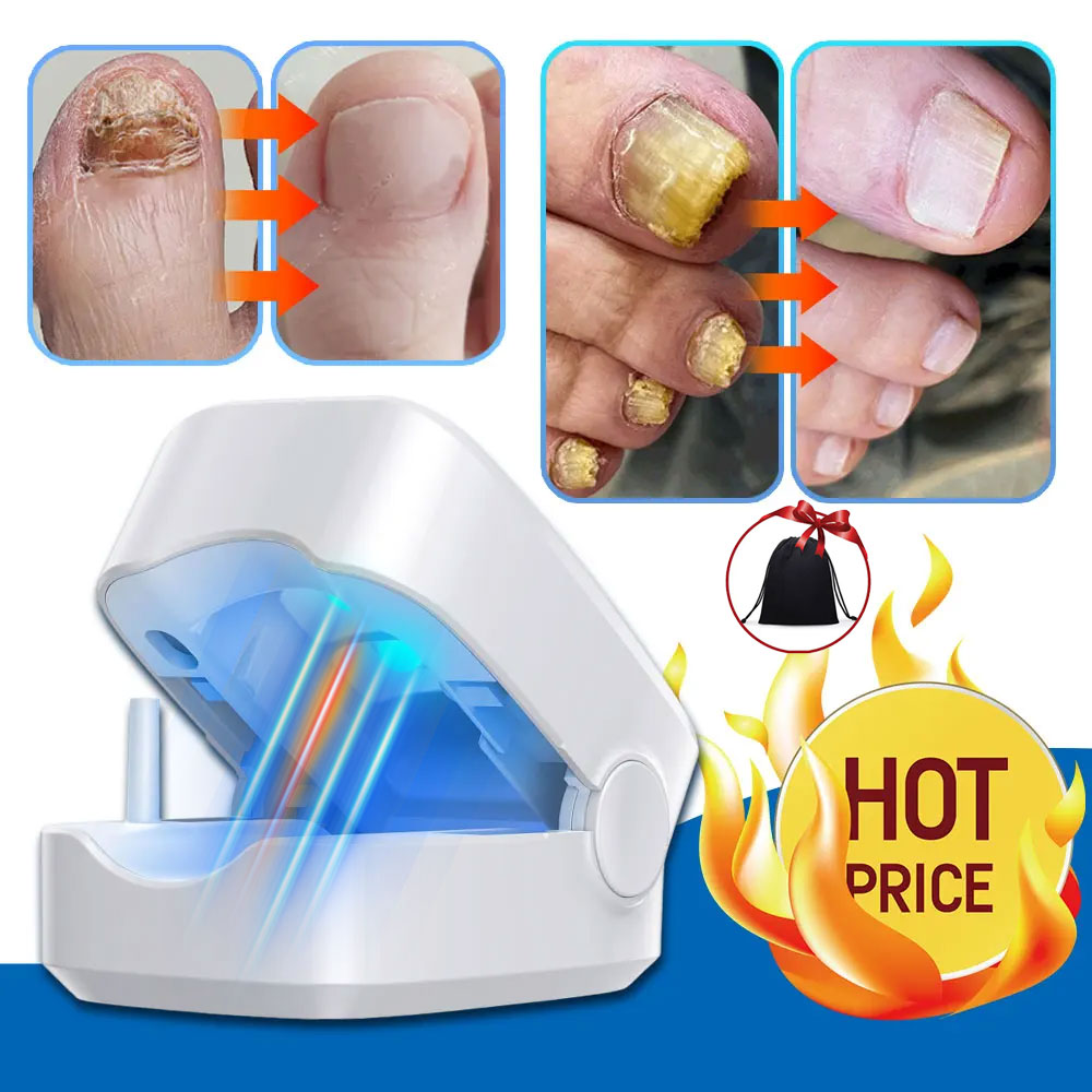 Toenail Machine Yuanyan Nail Fungus Laser Treatment Device Repair Toenail Fingernail ...