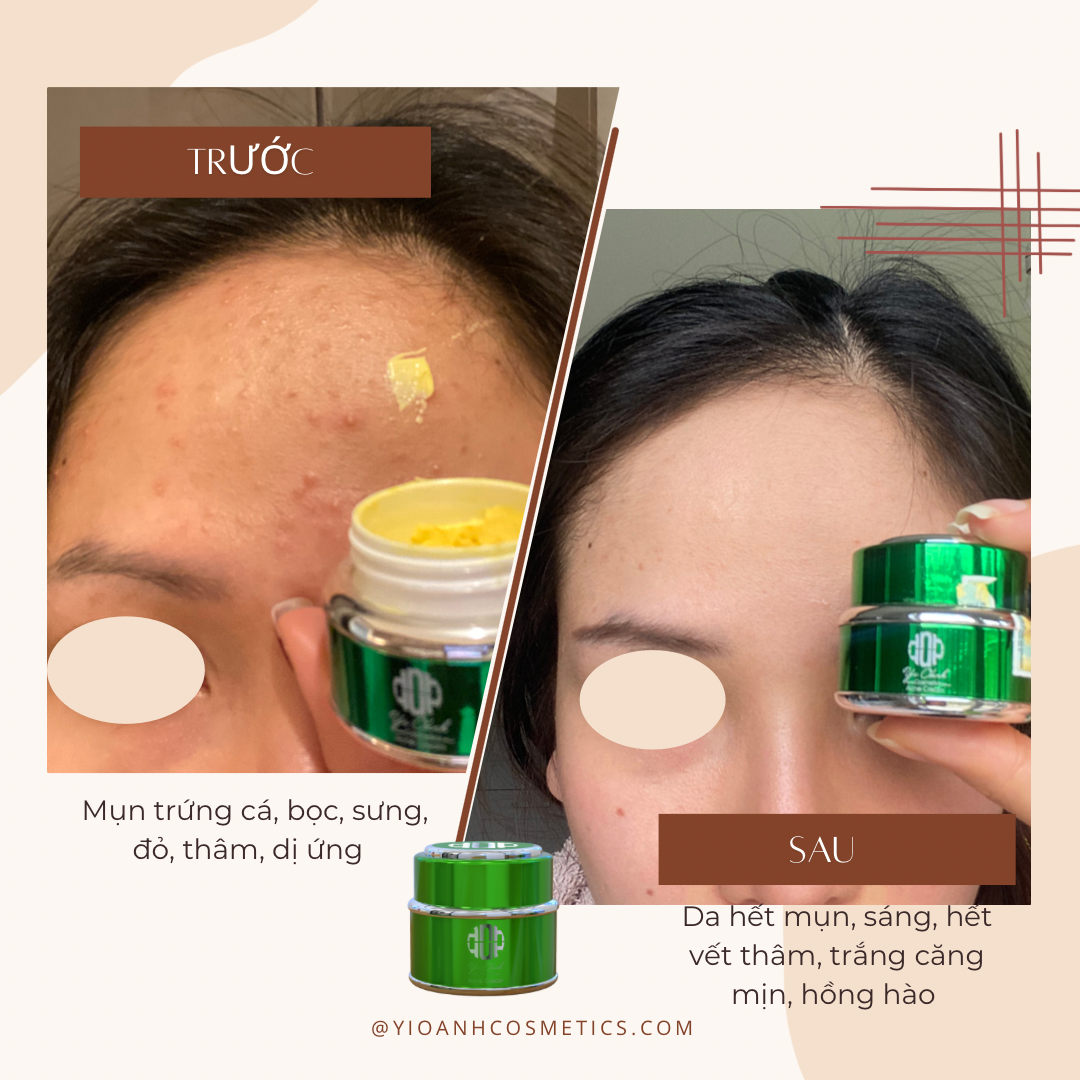 Kem Mụn - Thâm Mụn Acne Cream