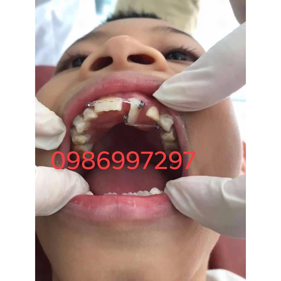 Button cánh tròn núm chỉnh nha dễ thao tác