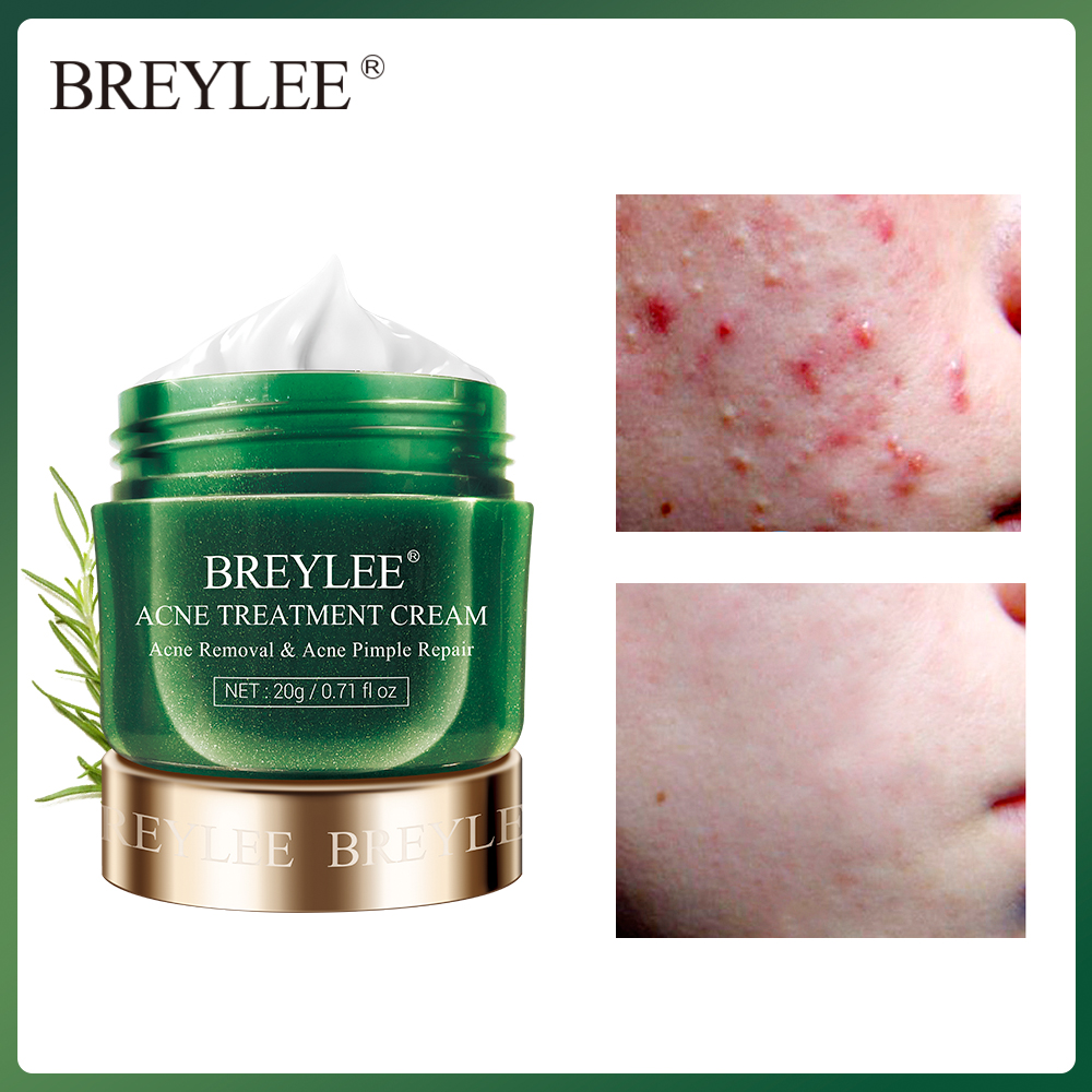 cream for acne on face