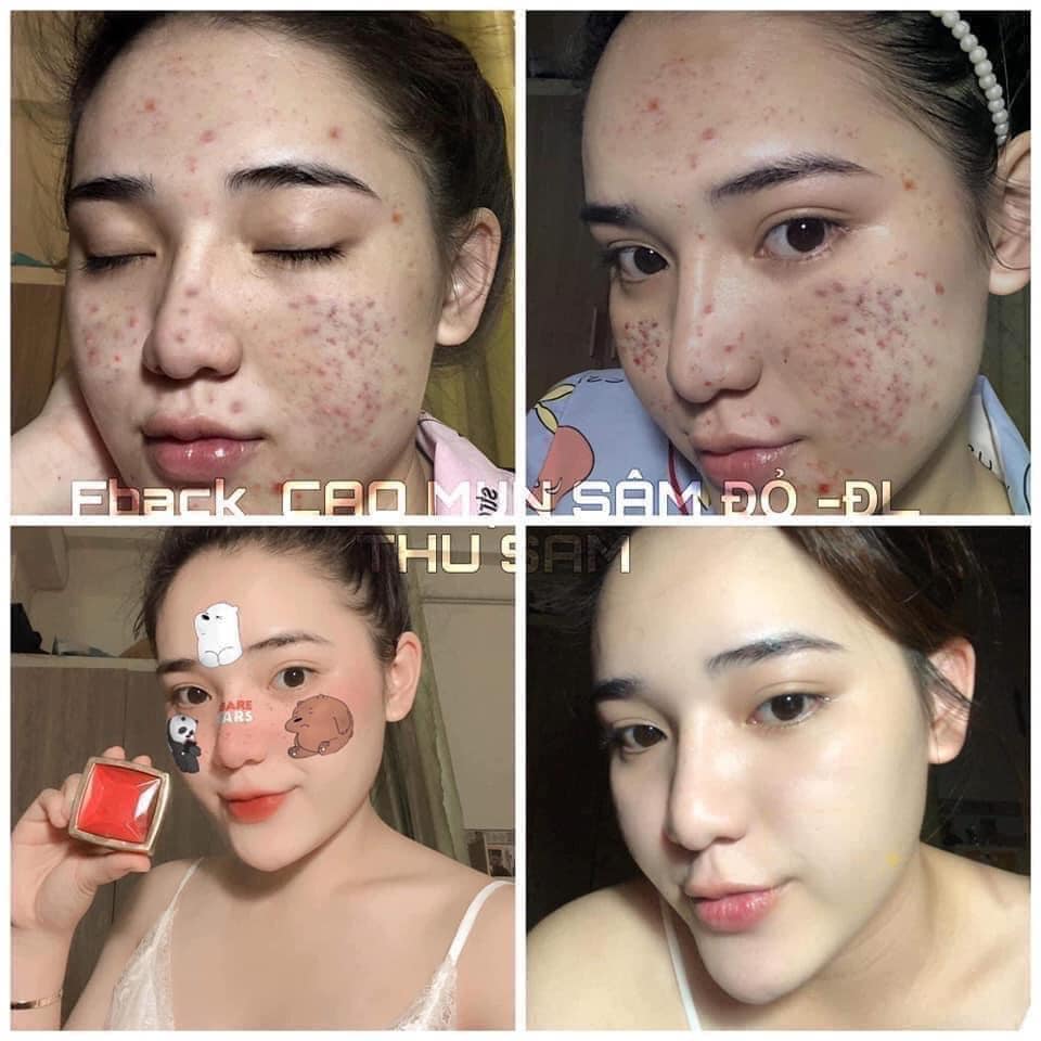 Cao Mụn Sâm Đỏ 36 Vị MEEA ORGANIC - Làm Đẹp Da