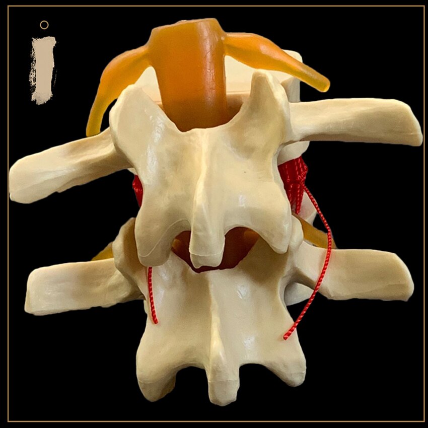Anatomical Human Lumbar Vertebrae Degenerative Lumbar Disc Herniation Demonstration Model Human Spine Model - White, Yellow
