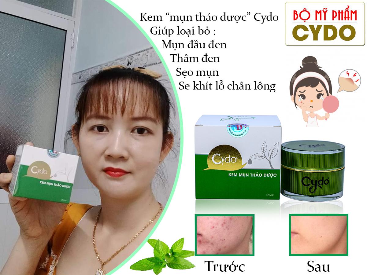 KEM MỤN THẢO DƯỢC CYDO