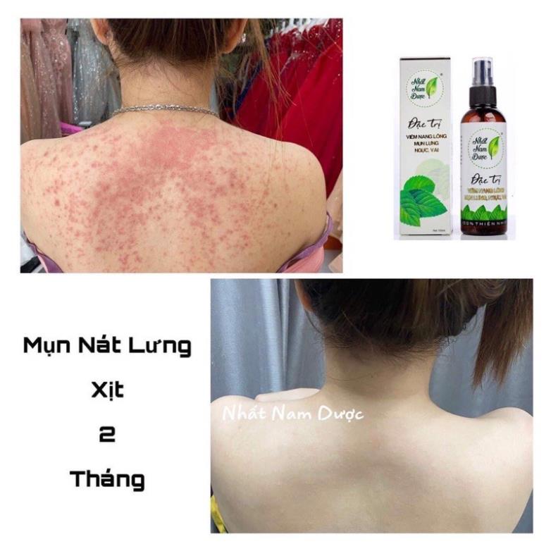 Xịt mụn lưng Hoàng Thiên Sâm 100ml