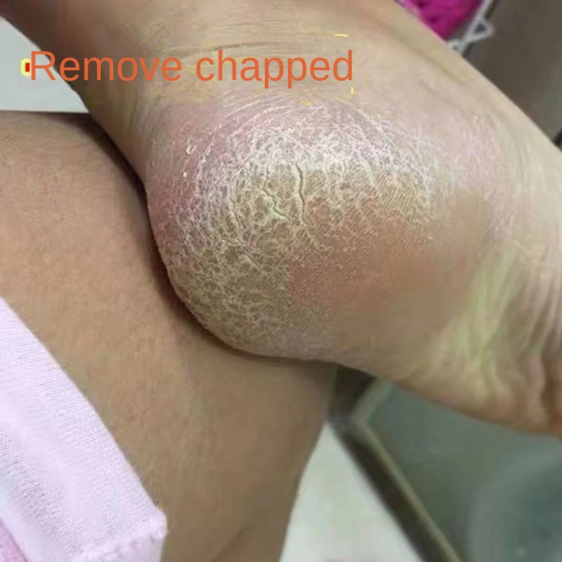 Yuanyan%20Foot%20Cleanser%20Exfoliator%20Softener%207%20Seconds%20Remove%20Dead%20Skin%20Calluses%20Foot%20Mask%20Anti-Cracked%20Heel%20Enhancer%20Nail%20Pedicure%20Kit%20-%20Image%204