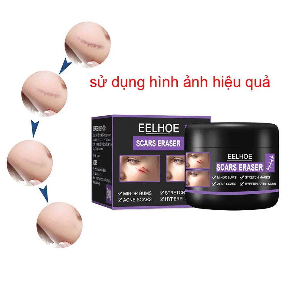 Kem xóa sẹo loại bỏ hiệu quả các vết sẹo lâu năm sẹo phẫu thuật phục hồi và làm sáng các vết rạn da khi mang thai xóa vết bỏng vết cắn và các vết sẹo khác vết thương trên mặt và cơ thể