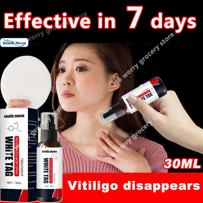 【100 effective】South Moon vitiligo remover 30ML vitiligo treatment