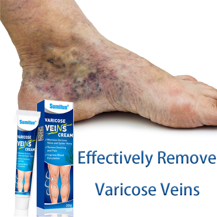 Relieve Varicose Sumifun Varicose Veins Remover For Legs,Varicose Veins ...