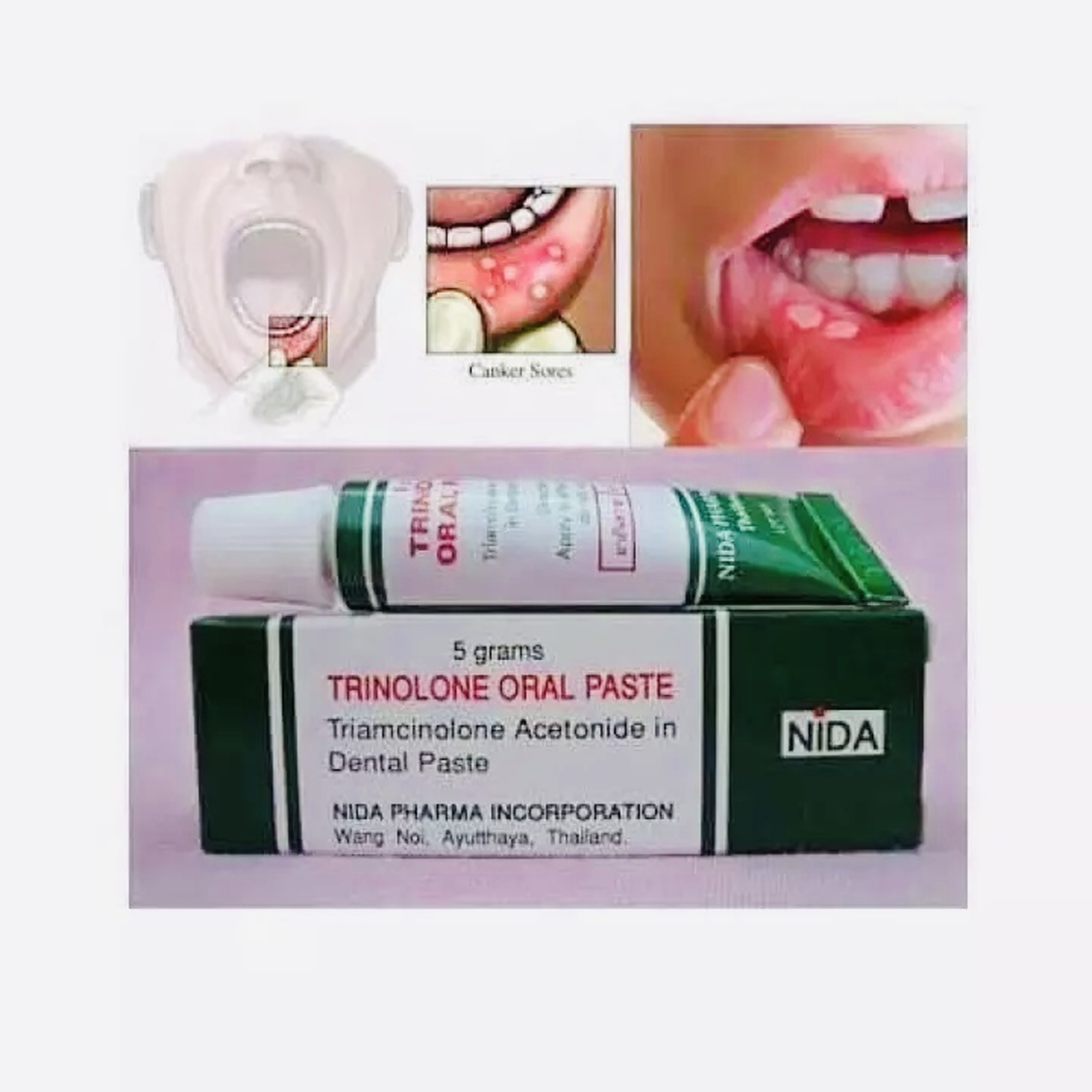 [Hcm]Trinolone Oral Paste Mouth Ulcer Cream Thailand