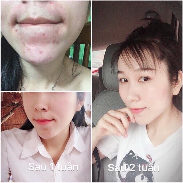 Mặt nạ thải độc CO2 (hộp 5 set)