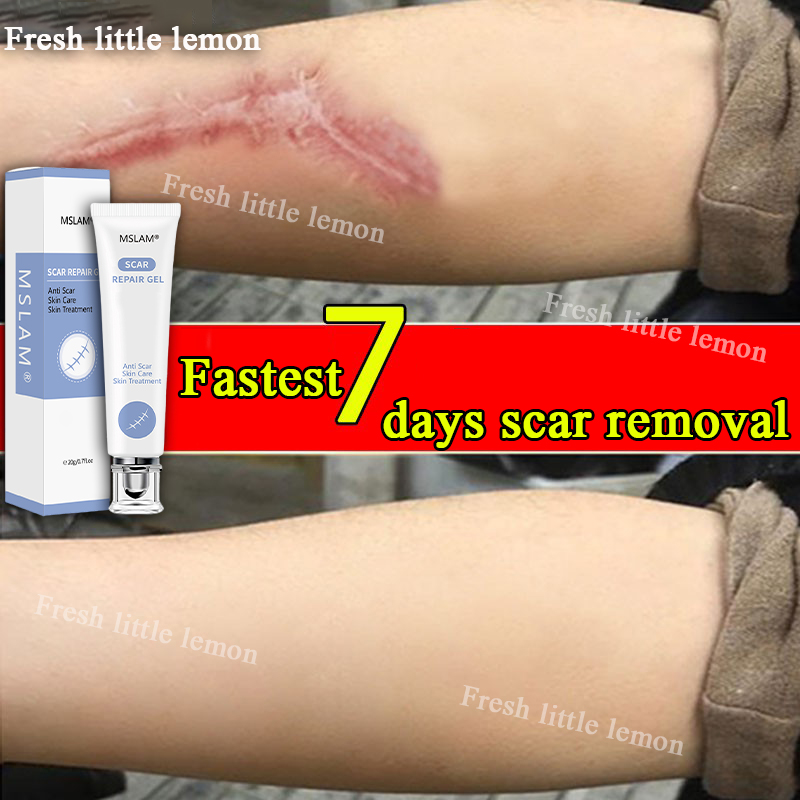 7 days fast scar removalMSLAM Scar Removal Cream repairing surgical