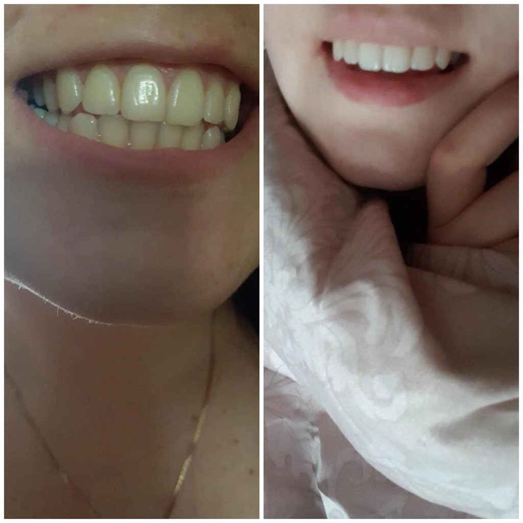 Kem đánh răng GLORY SMILE trắng răng than tre hoạt tính