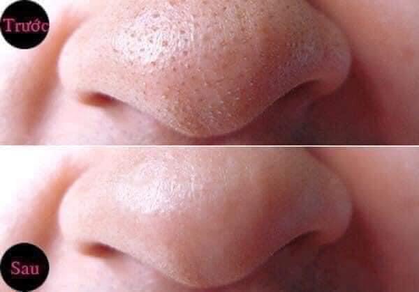 MÁY HÚT MỤN CẦM TAY