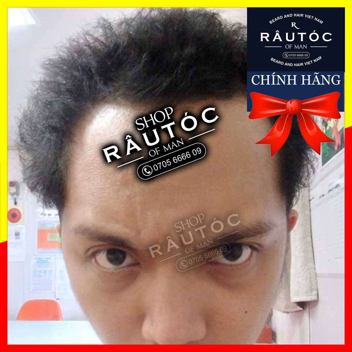 [HCM]Minoxidil 5% Rogaine
