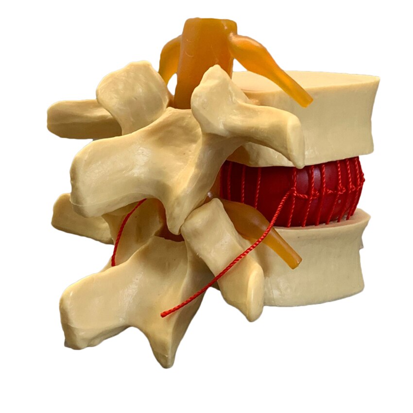 Anatomical Human Lumbar Vertebrae Degenerative Lumbar Disc Herniation Demonstration Model Human Spine Model - White, Yellow
