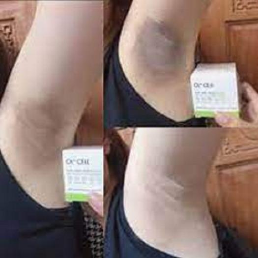 Cm]chính hãng ] kem xóa thâm nách, thâm môi thâm đầu gối ol-cell