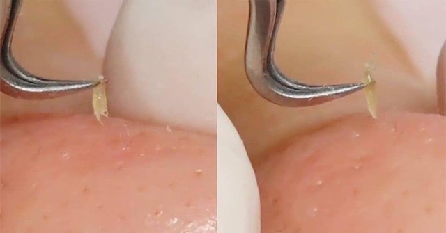 NHÍP GẮP MỤN THẦN THÁNH HÀN QUỐC