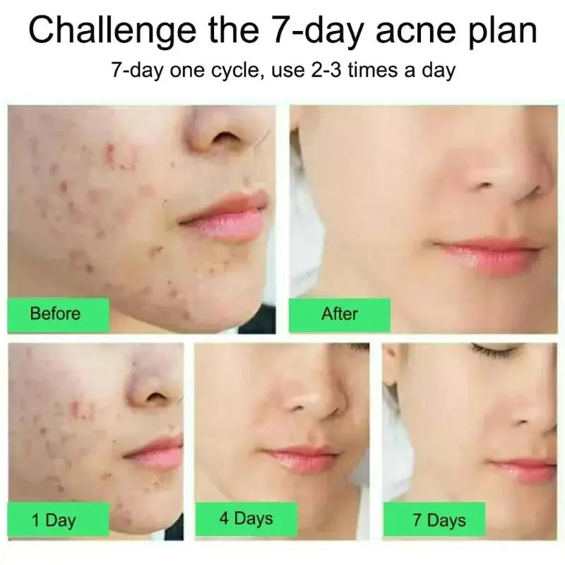 Anti-acne%20Treatment%20Cream%20Salicylic%20Acid%20Acne%20Deep%20Cleaning%20Pore%20Repair%20Pimple%20Spots%20Shrinking%20Oil%20Control%20Moisturizer%20Skin%20Care%20-%20Image%204