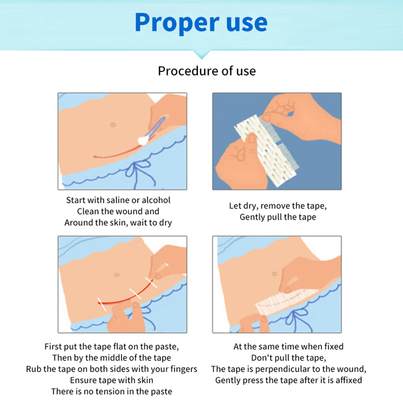 Stitch%20Free%20Adhesive%20Tape%20For%20Medical%20Wound%20Closure%20Strips%20Surgical%20Sutures%20Postpartum%20Wound%20Repair%20Cosmetic%20Adhesive%20Medical%20ZHIXING%20-%20Image%204