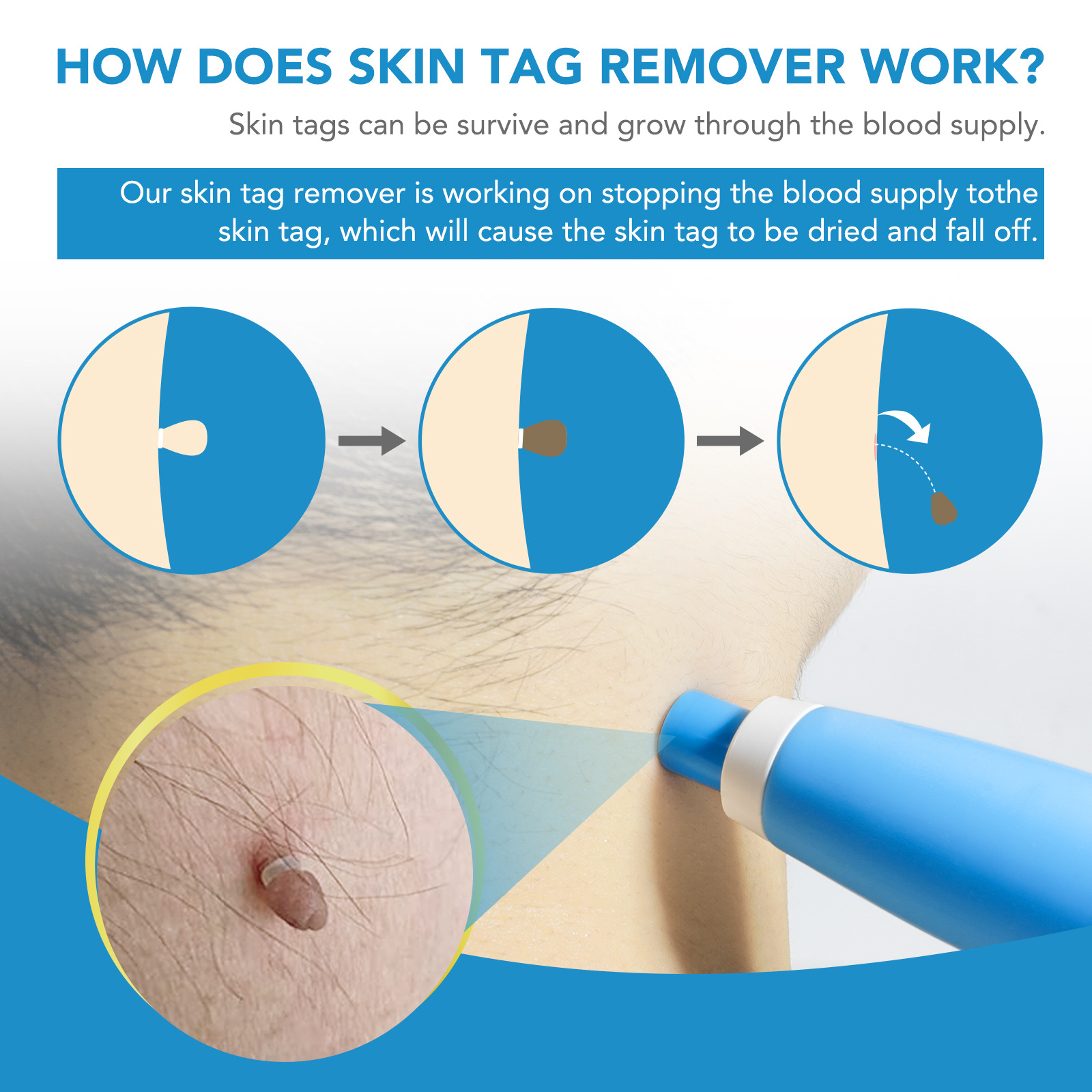 %E3%80%90Value%20Bundle%E3%80%91%202%20IN%201%20Auto%20Skin%20Tag%20Remover%20Kit%20Skin%20Tag%20Removal%20Device%20Mole%20Stain%20Wart%20Remover%20Care%20Skincare%20Pen%20Removal%20Set%20-%20Image%202
