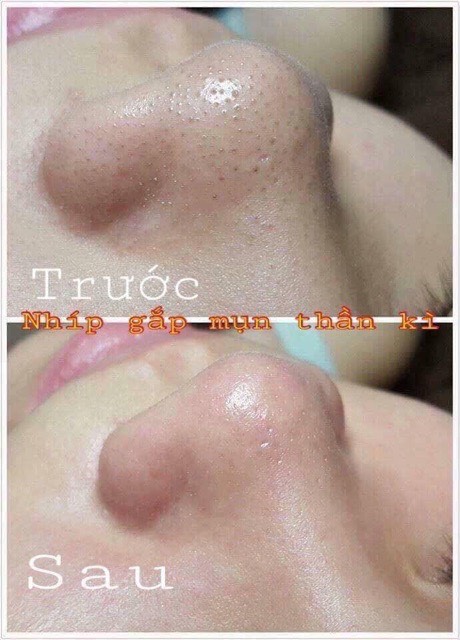 NHÍP GẮP MỤN THẦN THÁNH HÀN QUỐC