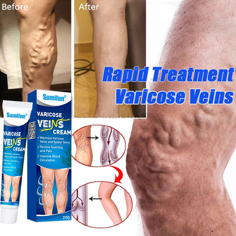 SUMIFUN Varicose Veins Remover for Legs for Varicose Analgesia Anti