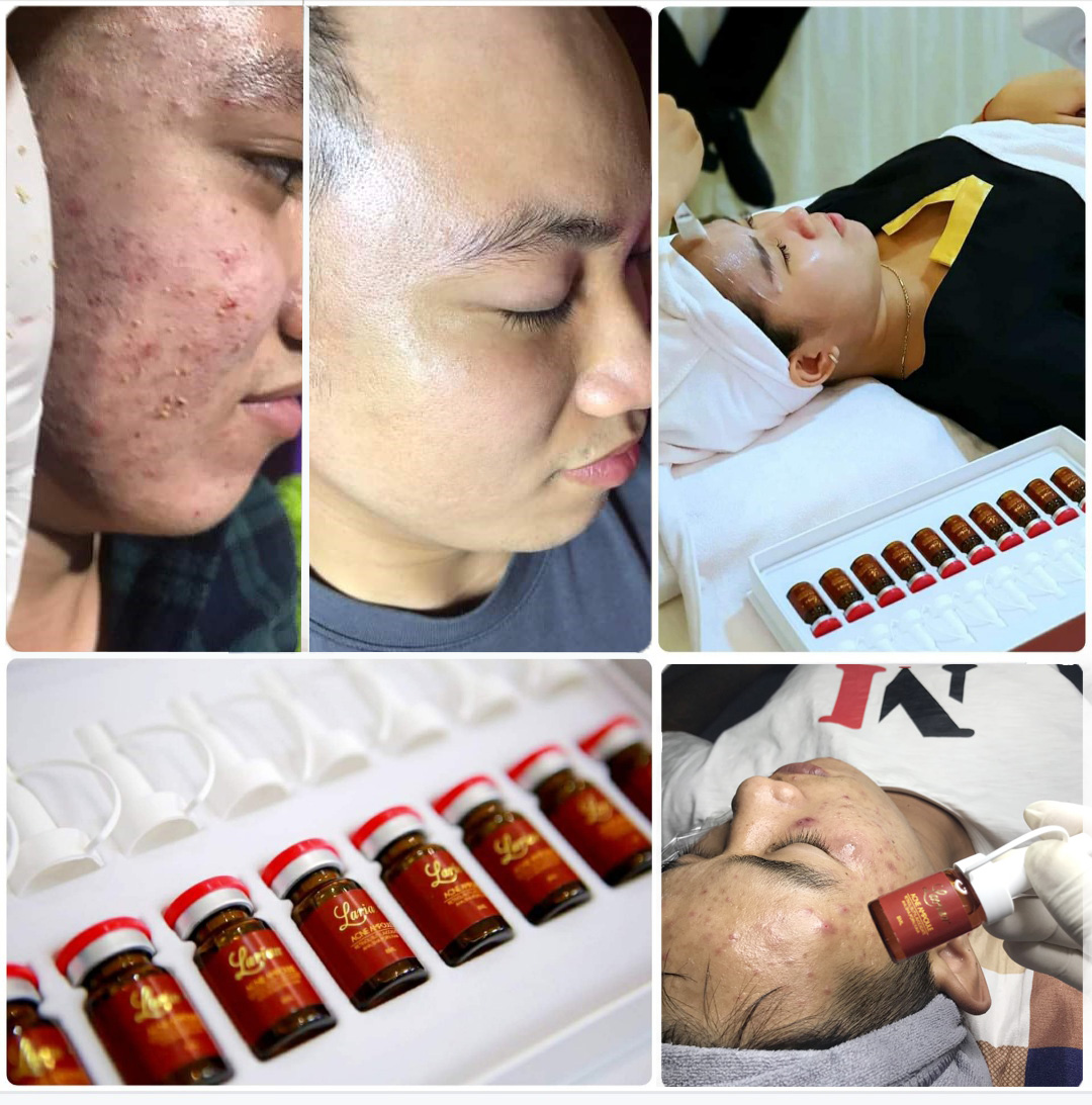 Tế bào gốc trị Mụn DNA cá hồi (LARIAN ACNE AMPOULE)