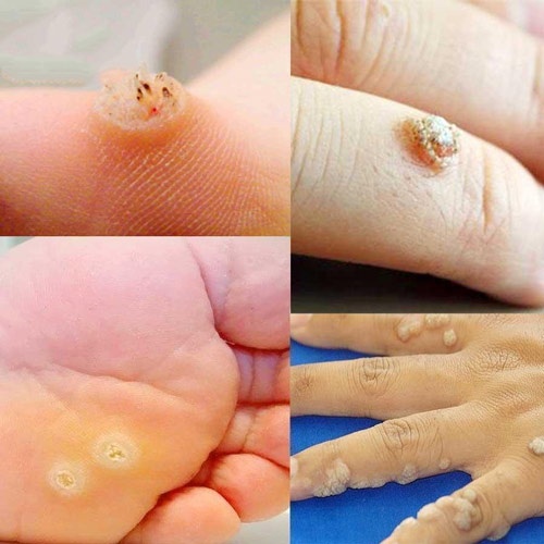 Lọ bôi loại mụn cóc, mụn cơm, mụn thịt, mắt cá chân