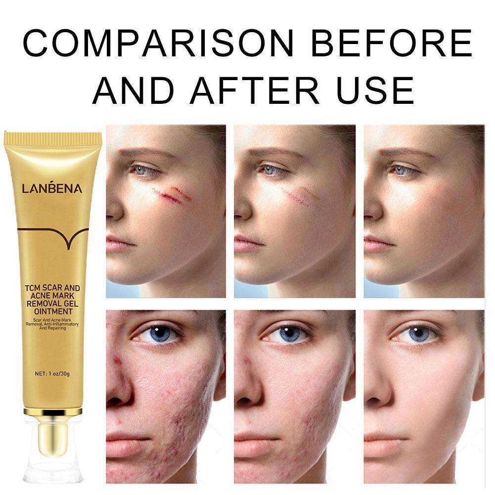 Lanbena%20TCM%20Scar%20And%20Acne%20Mark%20Removal%20Gel%20Ointment%2030G%20-%20Image%203