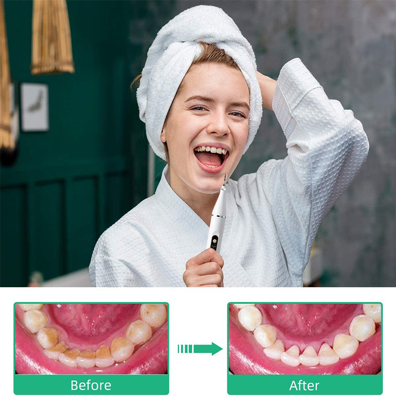 %E3%80%90Expert%20Recommended%E3%80%91%205-speed%20calculus%20removal%20ultrasonic%20scaler%20for%20teeth%20ultrasound%20tartar%20stone%20remover%20electic%20Sonic%20cleaner%20-%20Image%205