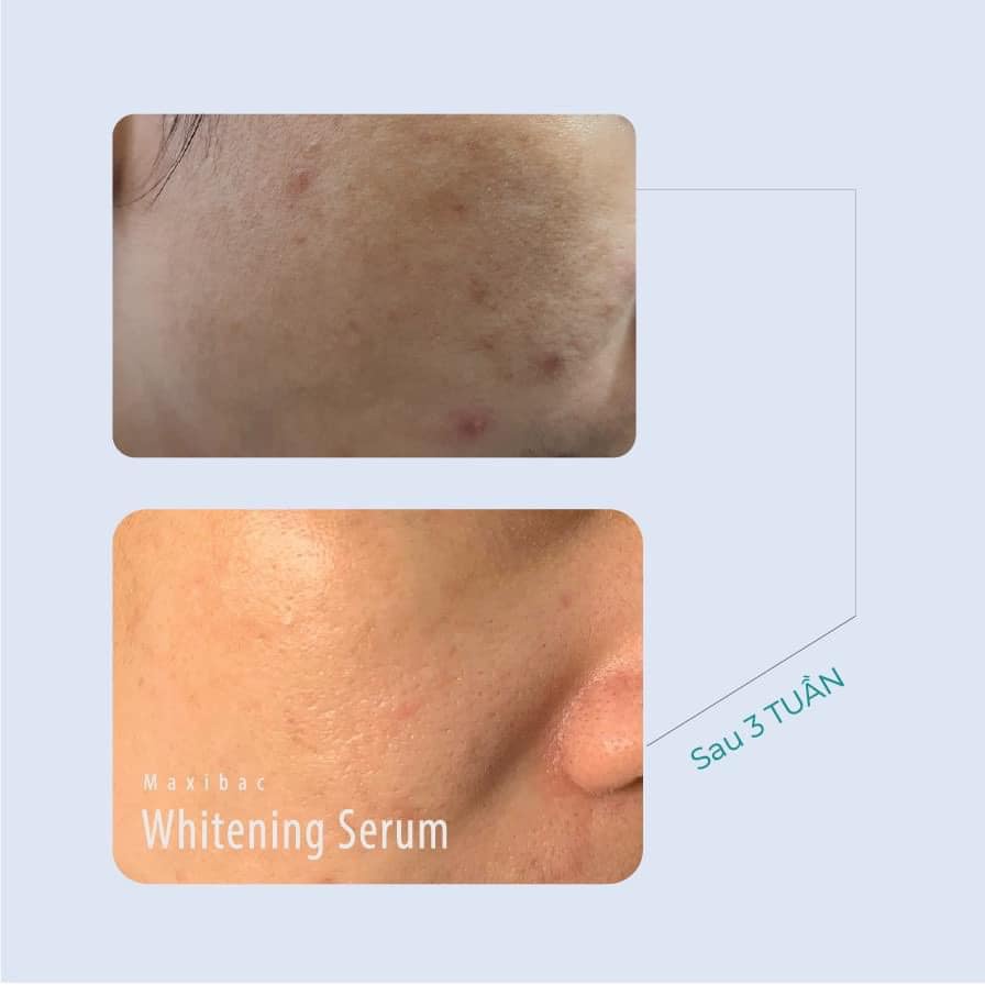 Maxibac Whitening Serum - Serum mờ ƞám dưỡng trắng da Maxibac