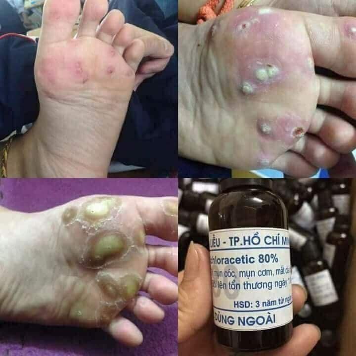 Lọ bôi loại mụn cóc, mụn cơm, mụn thịt, mắt cá chân