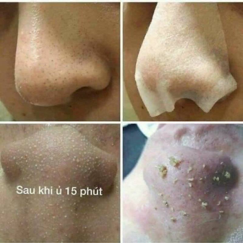 [HÀNG NGUYÊN SEAL][TẶNG MIẾNG BỌT BIỂN RỬA MẶT]Dung dịch ủ mụn MEDIPEEL (MEDI PEEL) CHAI 100ML