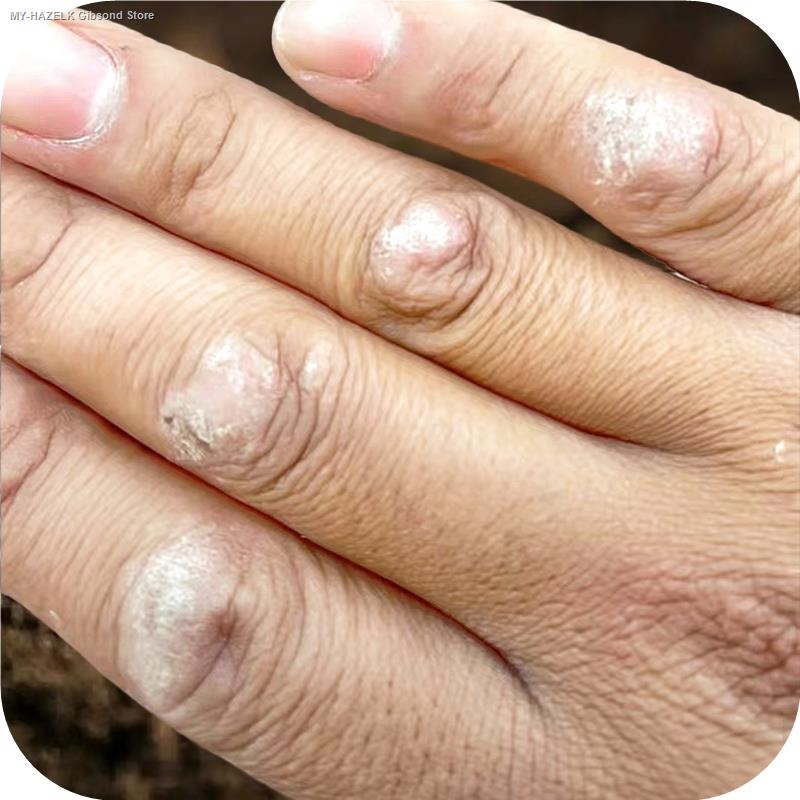 Ringworm of finger joints tinea manuum stubborn neurodermatitis itching