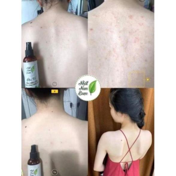 Xịt mụn lưng Hoàng Thiên Sâm 100ml